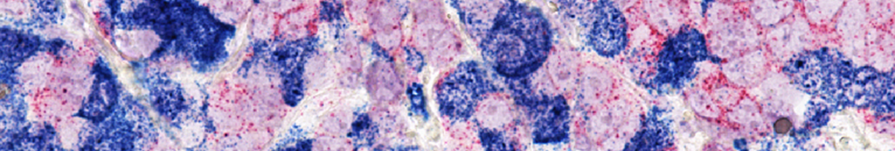 Image of breast cancer cells